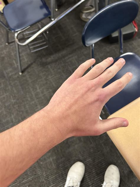 Why do my hands do this : r/DermatologyQuestions