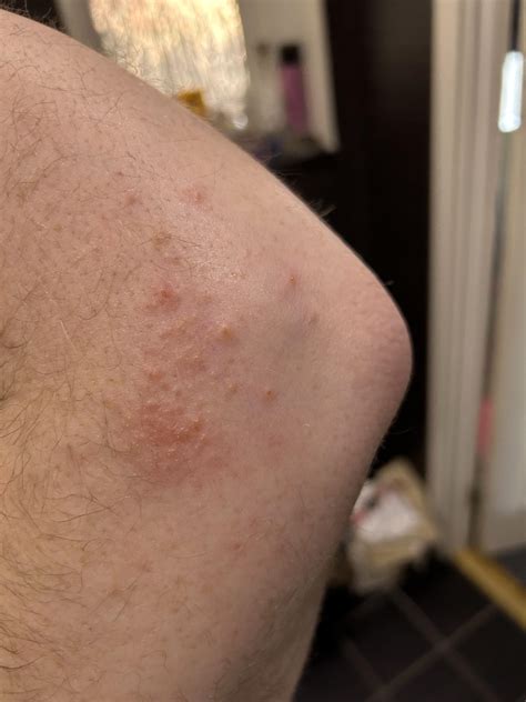 econazole vs miconazole vs clotrimazole vs terbanifine. Wich is the ...