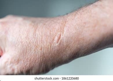 78 Skin Graft Scar Images, Stock Photos, 3D objects, & Vectors ...