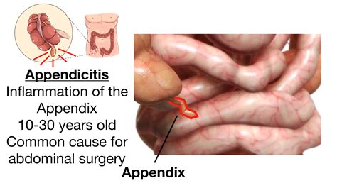 Appendicitis Pain: Symptoms, Signs, Causes, Diagnosis, Treatment — EZmed