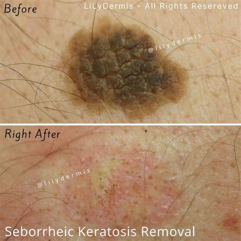 Seborrheic Keratosis Removal | LiLyDermis | Calgary | Alberta | Canada