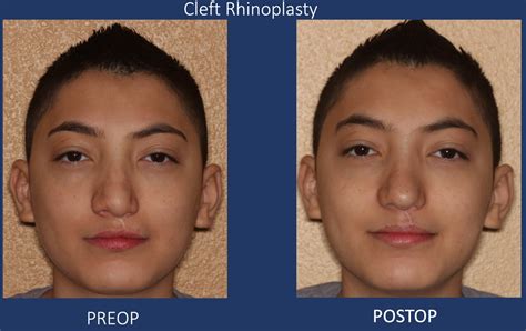 Before and After Gallery | Cleft Palate Surgeon El Paso TX