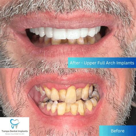 dental implant gallery tampa dental excellence