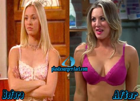 Kaley Cuoco Boob Job Before and After