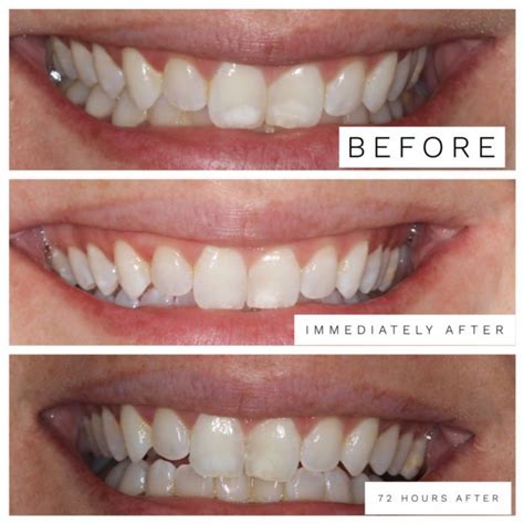 Getting rid of white spots on front teeth caused by braces and ...