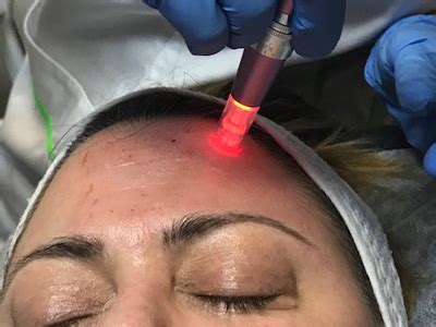 КОЛАГЕН ИНДУЦИРАНА ТЕРАПИЯ/ МИКРОНИДЛИНГ - beautyparlourbyst.com