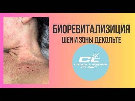 Биоревитализация шеи и зоны декольте - YouTube