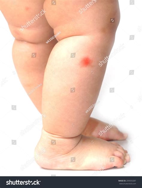 Red Spots Lower Legs