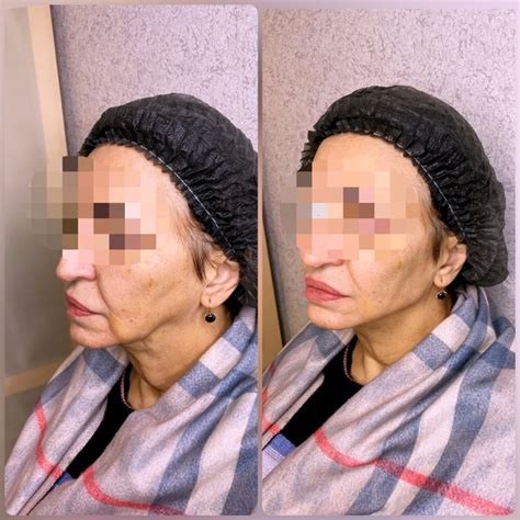 Полимолочная кислота, нижняя треть лица #косметологхимки #уходзалицом # ...