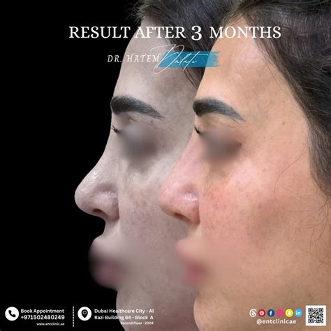 rhinoplasty  nasal deformities fractures  dubai