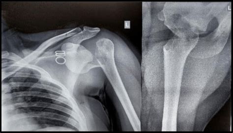 Radiograph AP and axial view of right shoulder. | Download Scientific Diagram