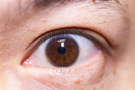 Bulging Cornea Stock Photos, Pictures & Royalty-Free Images - iStock
