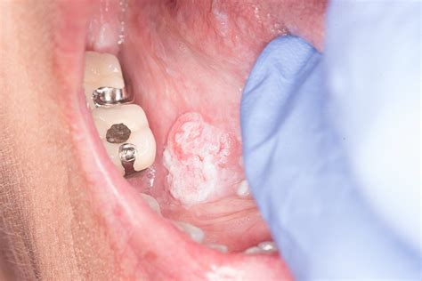 oral cancer facts diagnosis treatment ut md anderson