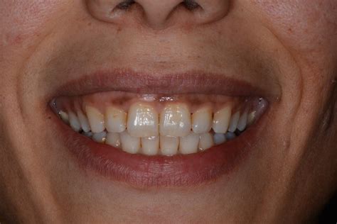 The Mystery Of Purpling Gums: 10 Secrets To Regaining A Healthy Smile