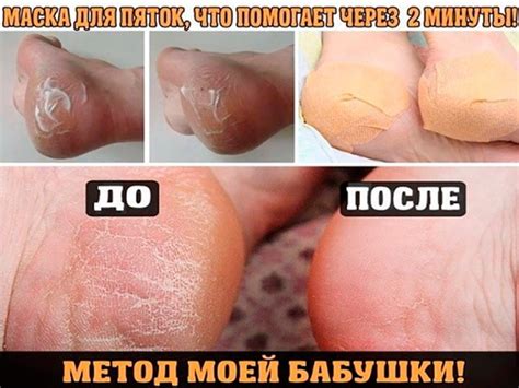 Домашнее СРЕДСТВО ДЛЯ ВАШИХ ПЯТОЧЕК! ПОМОГАЕТ ЗА МИНУТУ! И так….. Берём ...