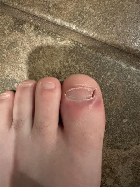 New to this : r/Ingrown_Toenails