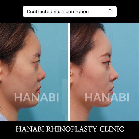 Improving the short nose with rhinoplasty (2) – HANABI RHINOPLASTY CLINIC