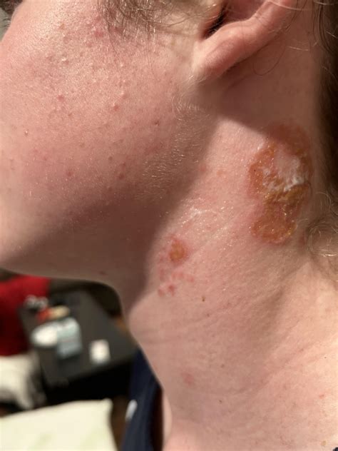 Is this ringworm? : r/medical_advice