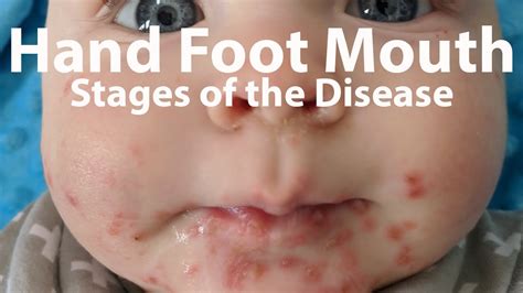 Hand Foot and Mouth Disease | HFMD | Symptoms & Duration - YouTube