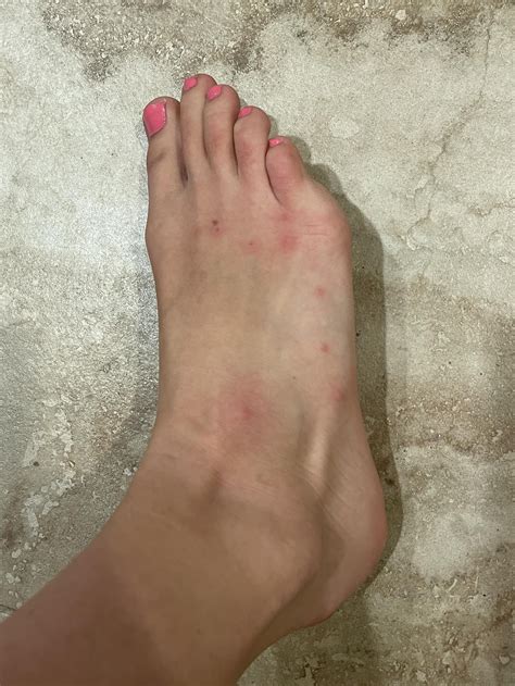 Are these bed bug bites? : r/bugbites
