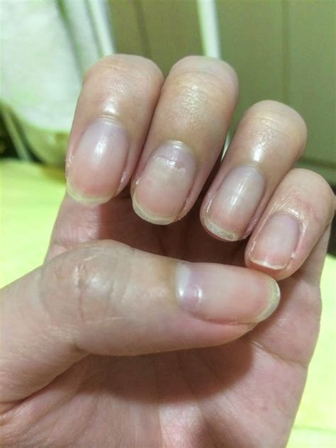 The Dettol Diaries: Peeling Fingernails after HFMD