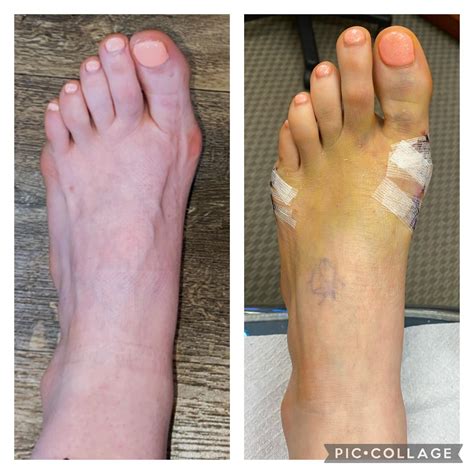 Should i get surgery on right feet? : bunions