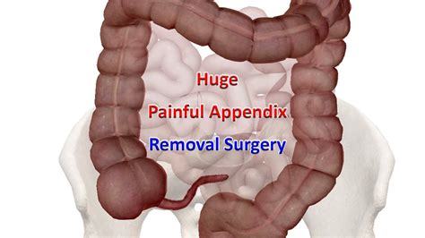 Laparoscopic Appendectomy | Huge Painful Appendix Removal Surgery - YouTube