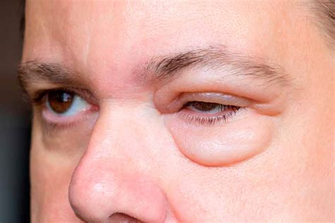 EYELID EDEMA: what it is, types and causes - Área Oftalmológica