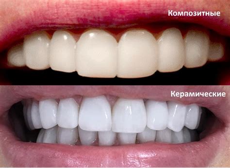 Цена установки композитных виниров на Можайском Шоссе в Москве ...