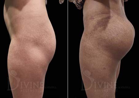 BBL Before and After | BBL Surgery Result