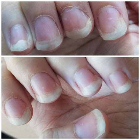 Why are my nails suddenly like this? How can I make them go back to