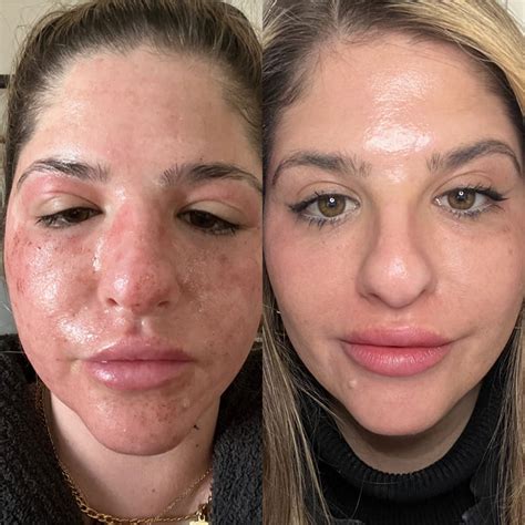 CO2 Resurfacing Laser: Before, During, After | RMA