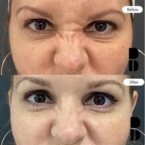 What is bunny lines? – BotoPlace