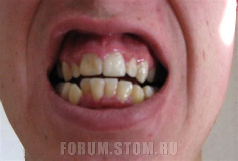Хочу полностью заменить зубы на имплантанты!!! - Протезирование ...
