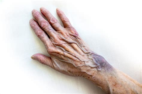 First Aid Tips for Hot Water Burns - FirstAidPro