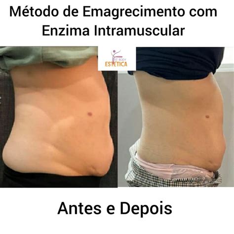 Enzima Intramuscular Antes E Depois - Método de Emagrecimento com Enzima Intramuscular