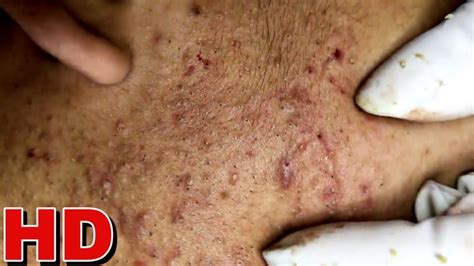 Unbelievable Blackhead Removal 2024: Say Goodbye to Pores! - xha4wk4