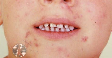 Infantile acne image