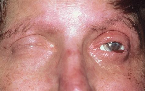 Ocular Surface Reconstruction in a Patient With Complete ...