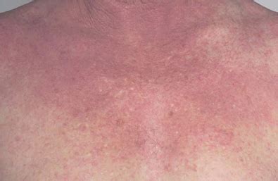 eczema  neck  chest