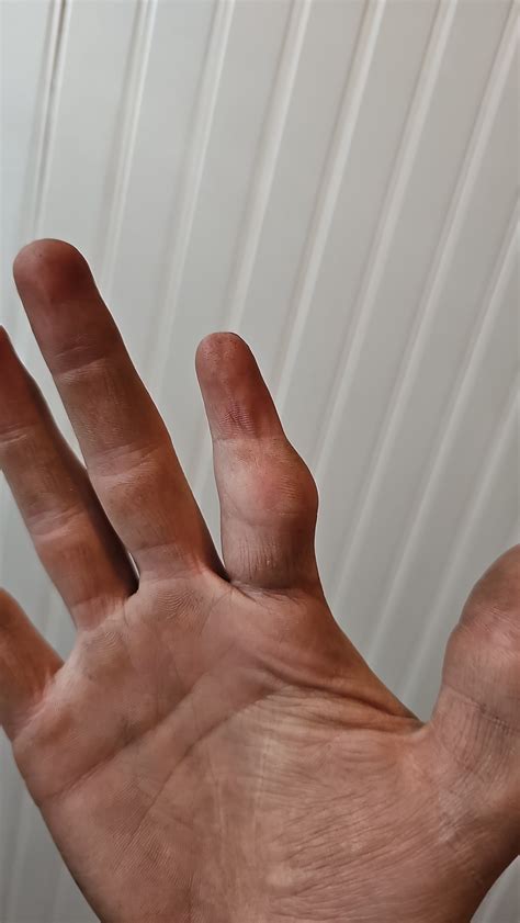 Doctors keep shaving my bones down and they grow back stronger : r