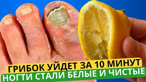 Этот ЯДРЁНАЯ Китайский Рецепт Разъест Весь Грибок с Ногтей! Лучшее ...