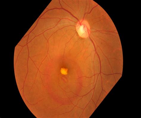 How to Use the Eye Disease Instance Segmentation API
