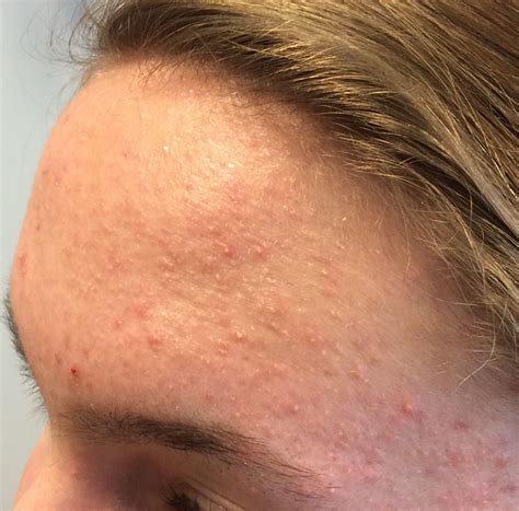 Folliculitis Face
