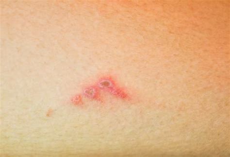 Bullous Impetigo In Adults