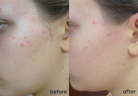 Review kem dưỡng SVR Sebiaclear Mat + Pores: kiềm dầu, thu nhỏ lỗ chân ...