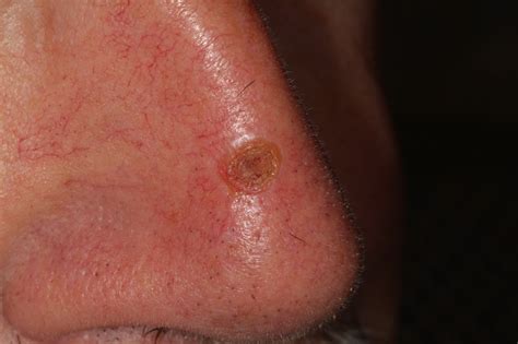 signs  skin cancer nose  ronnie anderson blog