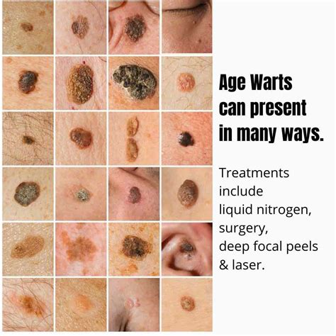 flat wart  chest  john hipple blog