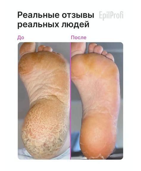 Гель EpilProfi от трещин и натоптышей — уход за пятками