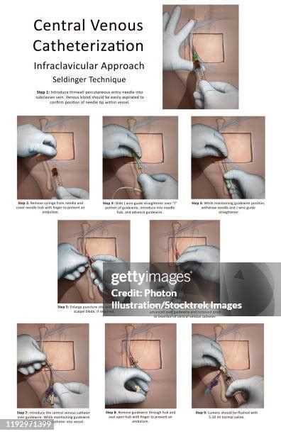 Central Line Catheter Photos and Premium High Res Pictures - Getty Images